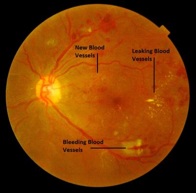 Diabetic Eye Disease