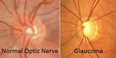 Glaucoma image